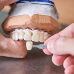 Crowns & Bridges-1-1000x1000